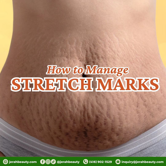 How to Manage STRETCH MARKS